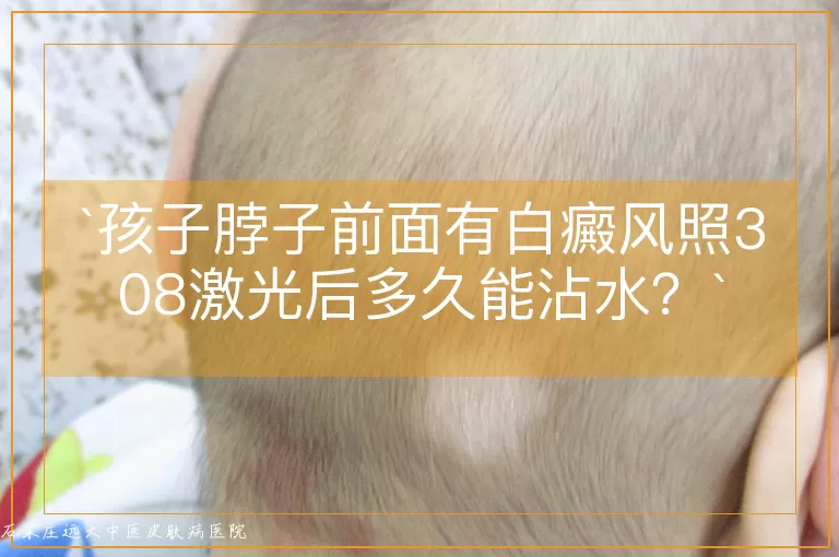 孩子脖子前面有白癜风照308激光后多久能沾水?