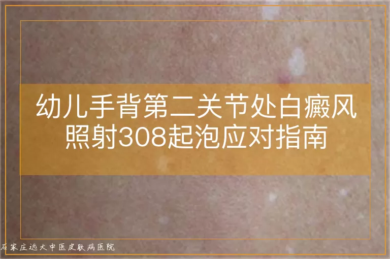 幼儿手背第二关节处白癜风照射308起泡应对指南