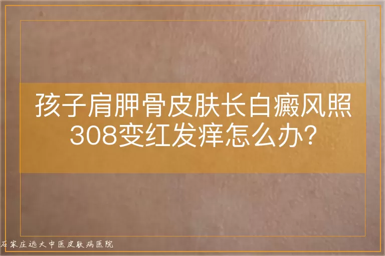 孩子肩胛骨皮肤长白癜风照308变红发痒怎么办？