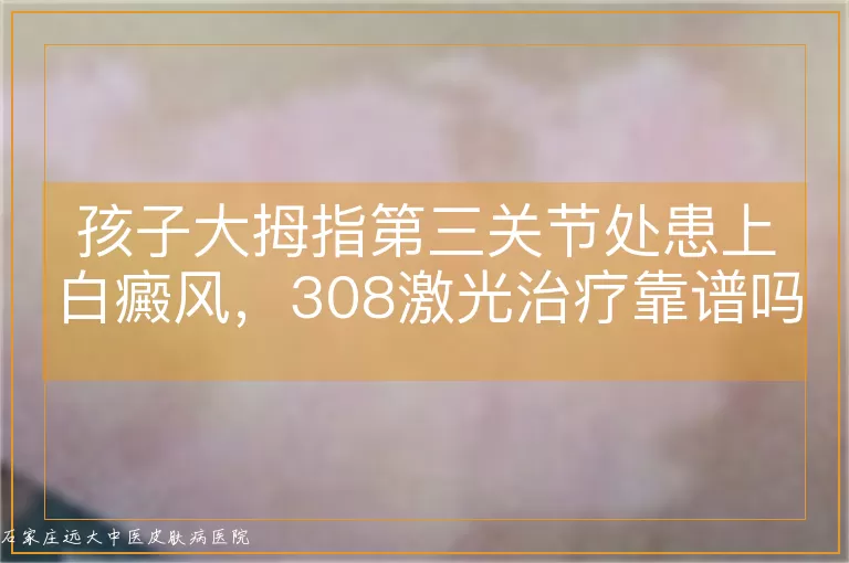 孩子大拇指第三关节处患上白癜风,308激光治疗靠谱吗?