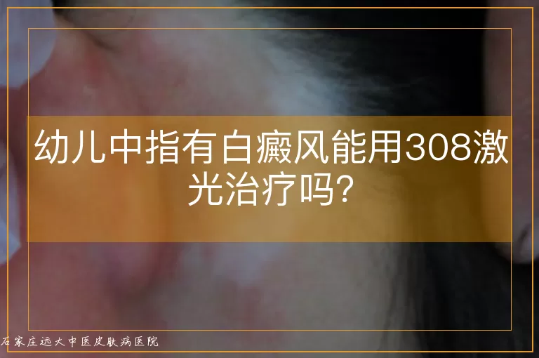 幼儿中指有白癜风能用308激光治疗吗?