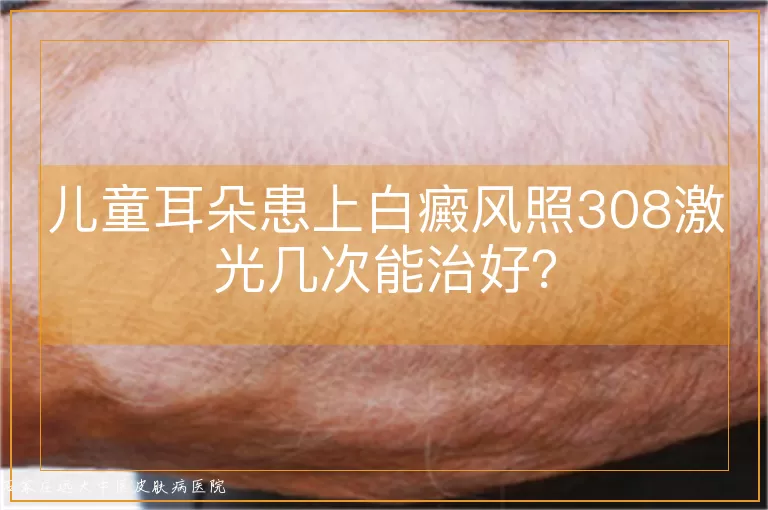 儿童耳朵患上白癜风照308激光几次能治好？
