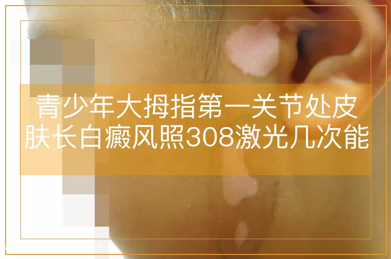 青少年大拇指第一关节处皮肤长白癜风照308激光几次能治好