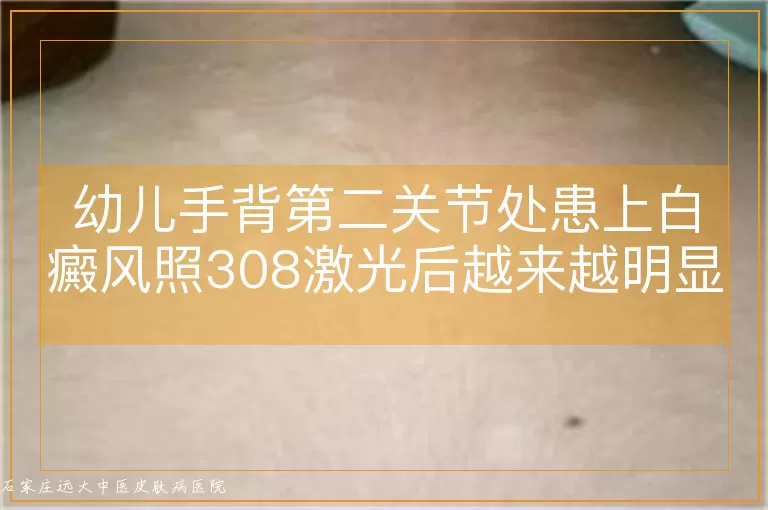幼儿手背第二关节处患上白癜风照308激光后越来越明显了怎么回事