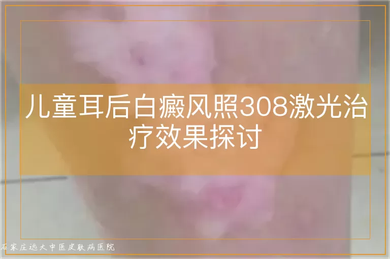 儿童耳后白癜风照308激光治疗效果探讨