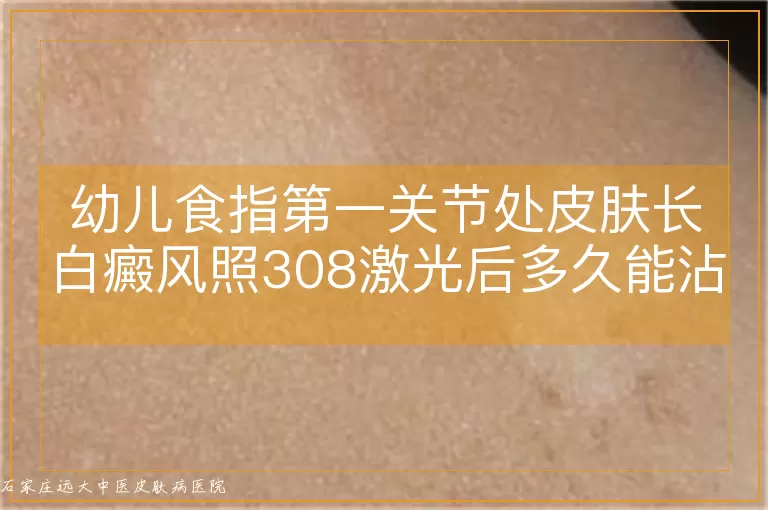 幼儿食指第一关节处皮肤长白癜风照308激光后多久能沾水?