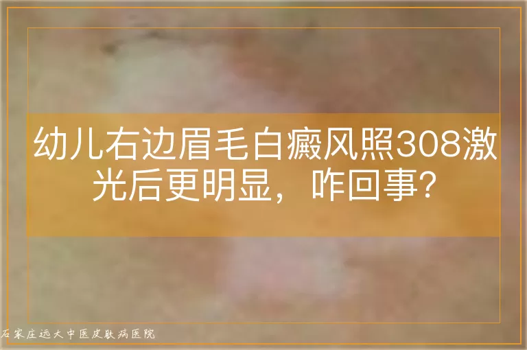 幼儿右边眉毛白癜风照308激光后更明显，咋回事？