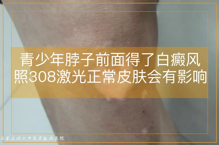 青少年脖子前面得了白癜风照308激光正常皮肤会有影响吗