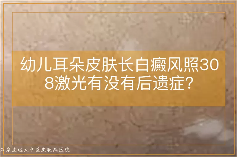 幼儿耳朵皮肤长白癜风照308激光有没有后遗症?