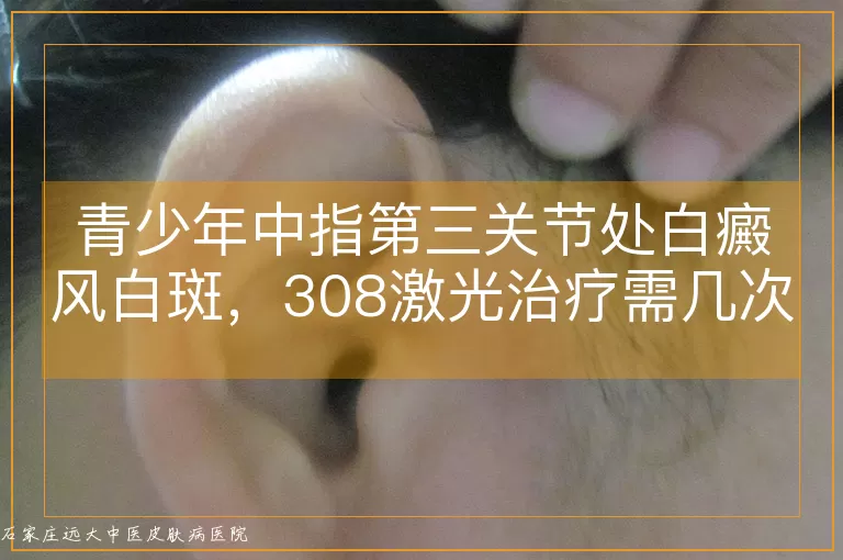 青少年中指第三关节处白癜风白斑，308激光治疗需几次见效？