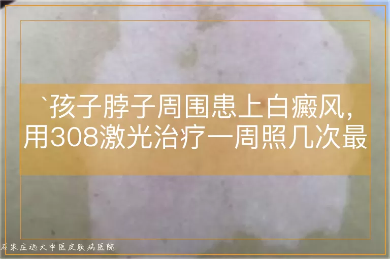 孩子脖子周围患上白癜风，用308激光治疗一周照几次最合适？