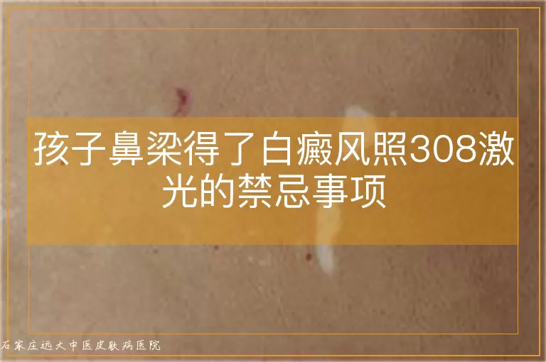 孩子鼻梁得了白癜风照308激光的禁忌事项