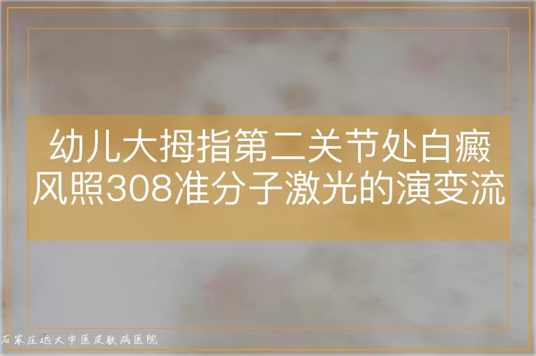幼儿大拇指第二关节处白癜风照308准分子激光的演变流程