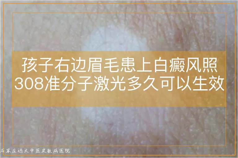 孩子右边眉毛患上白癜风照308准分子激光多久可以生效