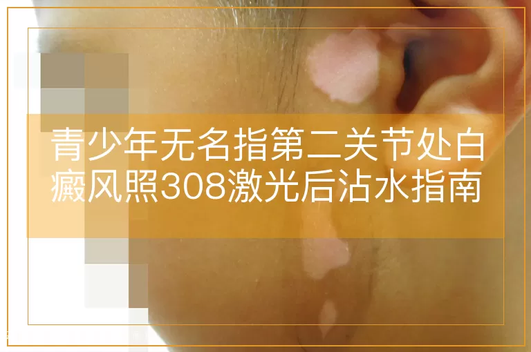 青少年无名指第二关节处白癜风照308激光后沾水指南