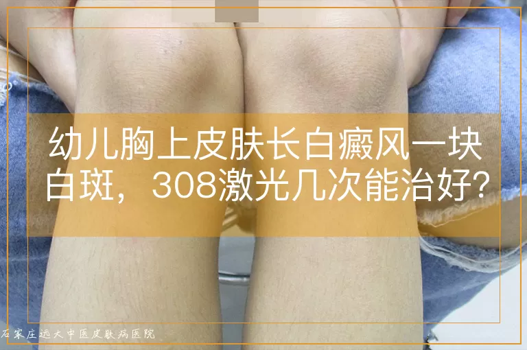 幼儿胸上皮肤长白癜风一块白斑,308激光几次能治好?
