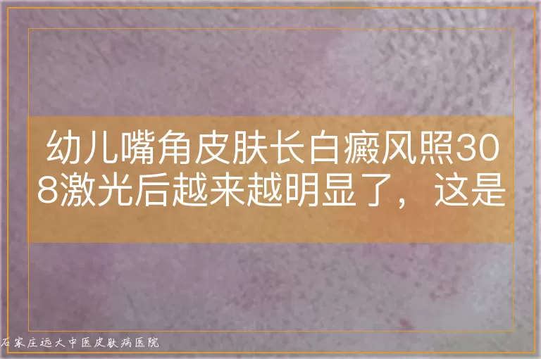 幼儿嘴角皮肤长白癜风照308激光后越来越明显了，这是怎么回事？