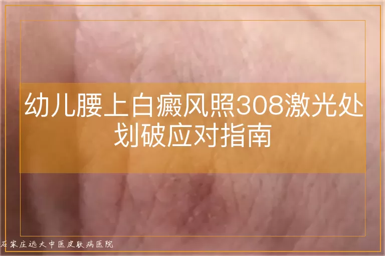 幼儿腰上白癜风照308激光处划破应对指南