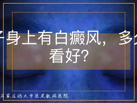 孩子身上有白癜风,多久能看好?