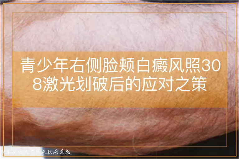 青少年右侧脸颊白癜风照308激光划破后的应对之策