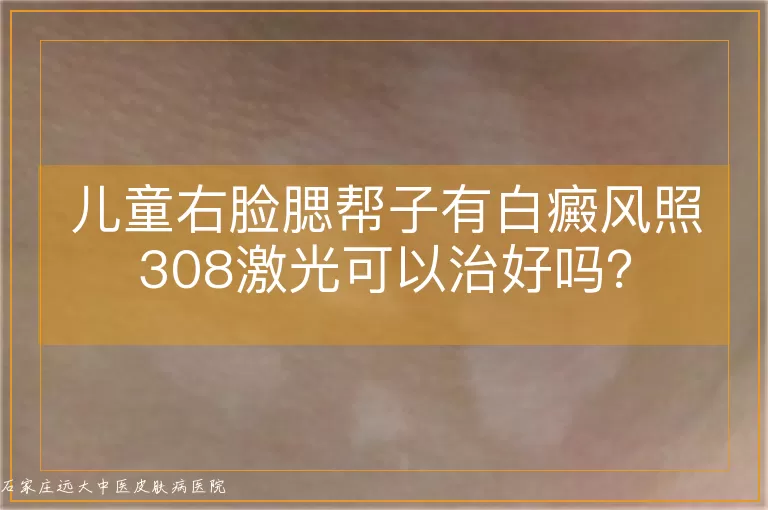 儿童右脸腮帮子有白癜风照308激光可以治好吗？