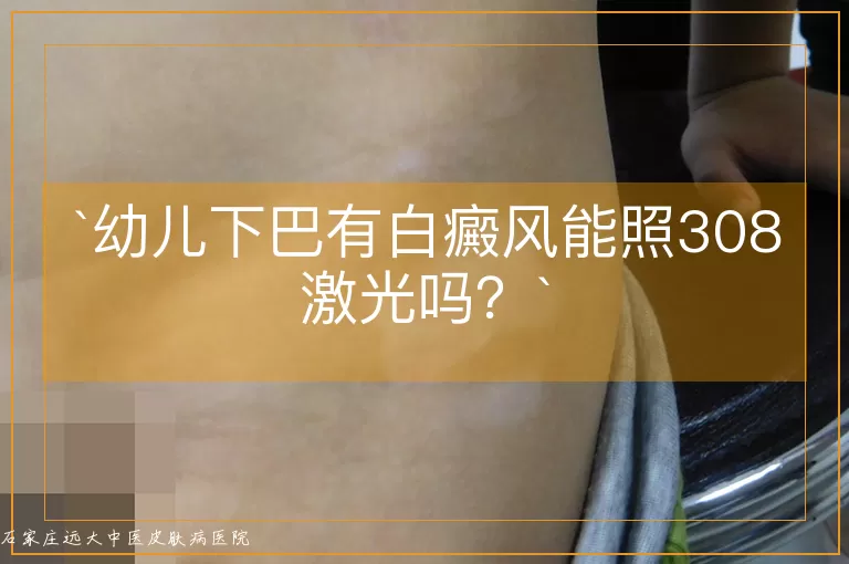 幼儿下巴有白癜风能照308激光吗？