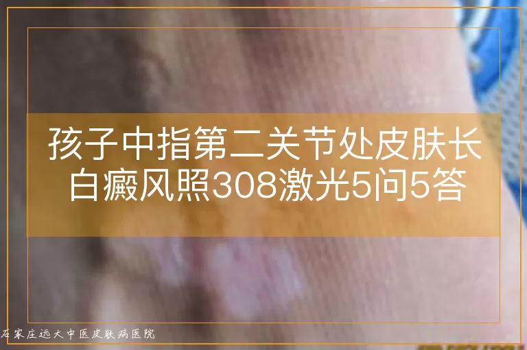 孩子中指第二关节处皮肤长白癜风照308激光5问5答