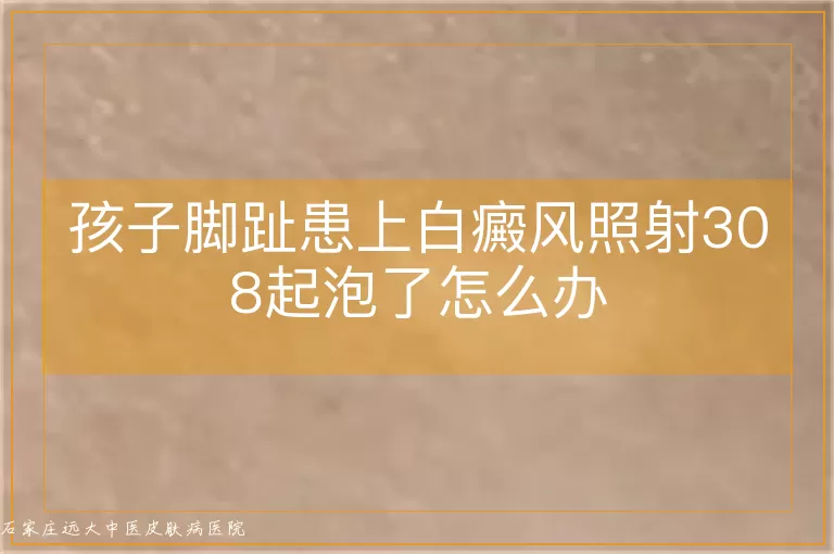孩子脚趾患上白癜风照射308起泡了怎么办