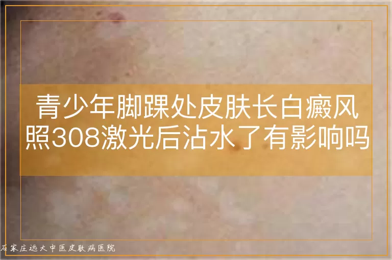 青少年脚踝处皮肤长白癜风照308激光后沾水了有影响吗