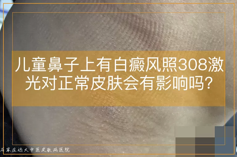儿童鼻子上有白癜风照308激光对正常皮肤会有影响吗？