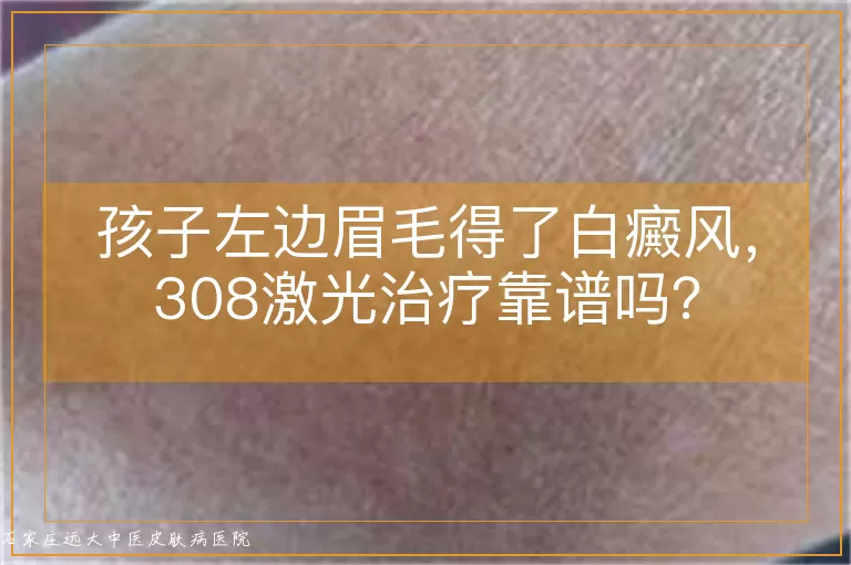孩子左边眉毛得了白癜风，308激光治疗靠谱吗？