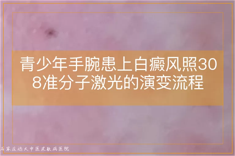 青少年手腕患上白癜风照308准分子激光的演变流程