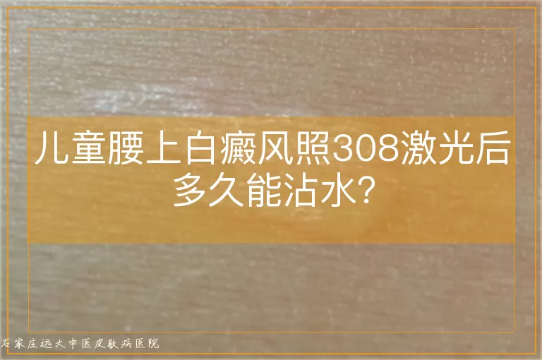 儿童腰上白癜风照308激光后多久能沾水？