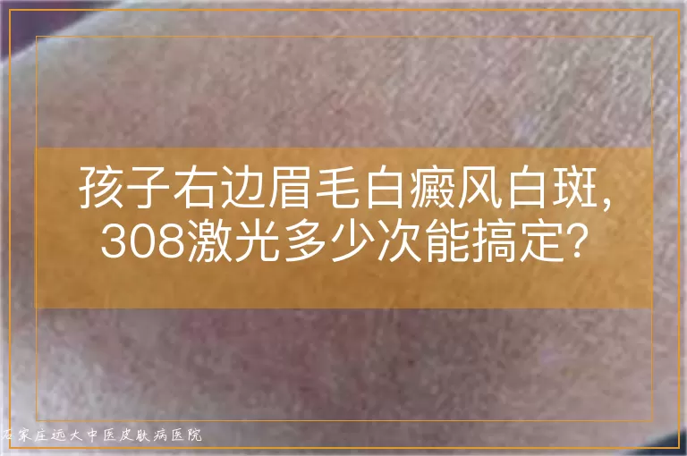 孩子右边眉毛白癜风白斑，308激光多少次能搞定？