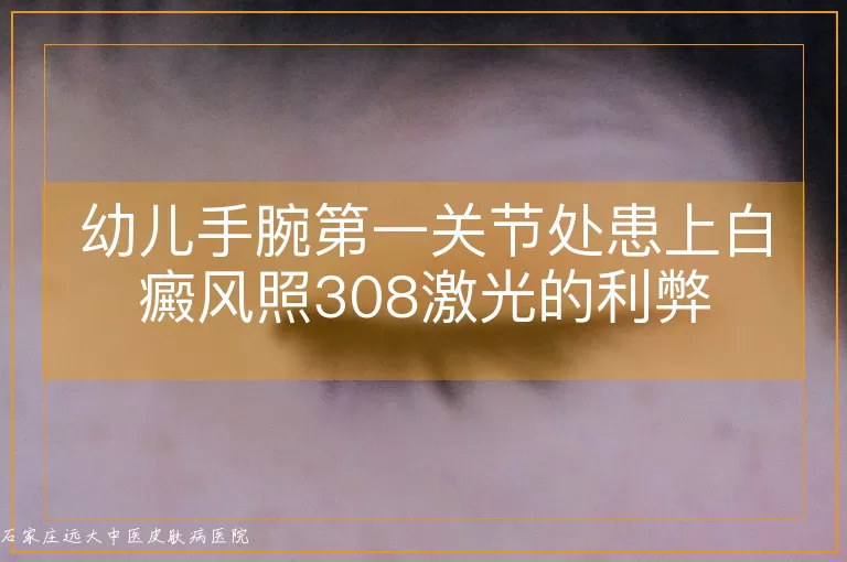 幼儿手腕第一关节处患上白癜风照308激光的利弊