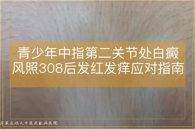 青少年中指第二关节处白癜风照308后发红发痒应对指南