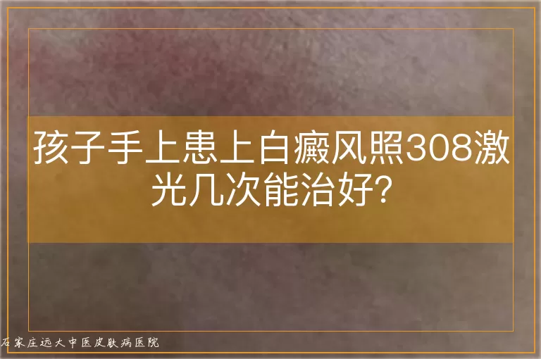 孩子手上患上白癜风照308激光几次能治好？