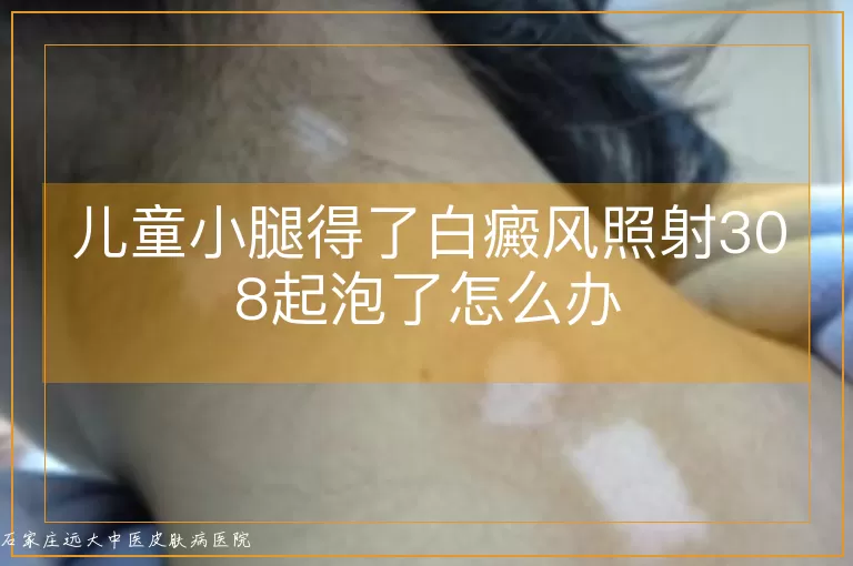 儿童小腿得了白癜风照射308起泡了怎么办