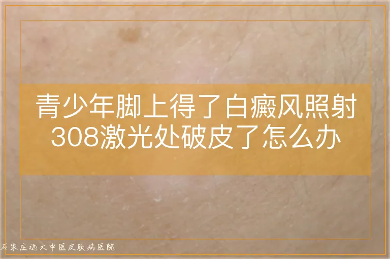 青少年脚上得了白癜风照射308激光处破皮了怎么办