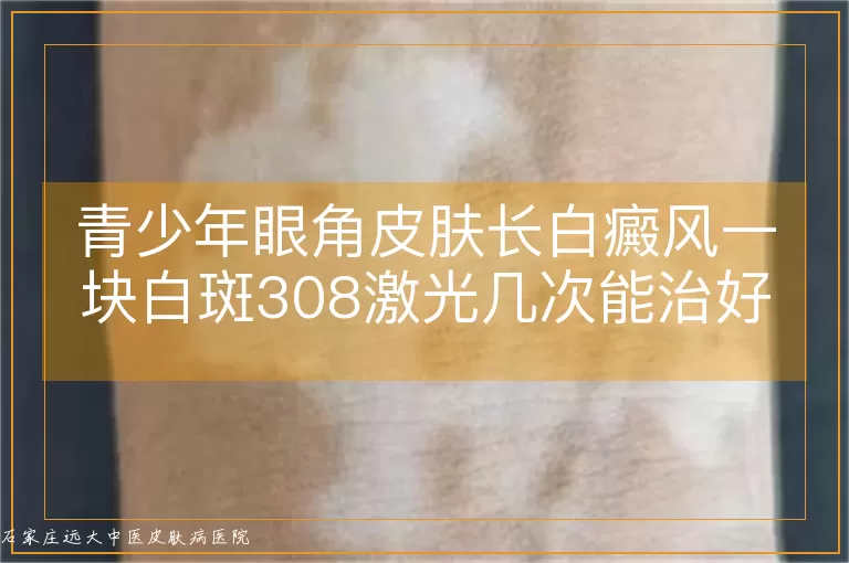 青少年眼角皮肤长白癜风一块白斑308激光几次能治好