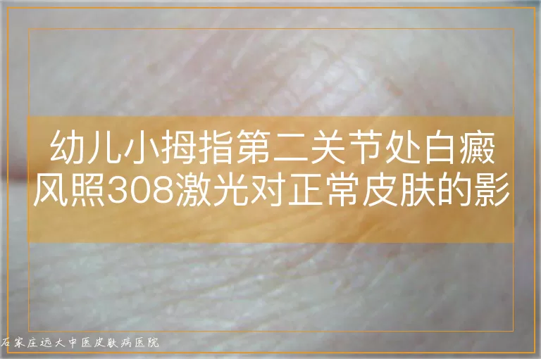 幼儿小拇指第二关节处白癜风照308激光对正常皮肤的影响