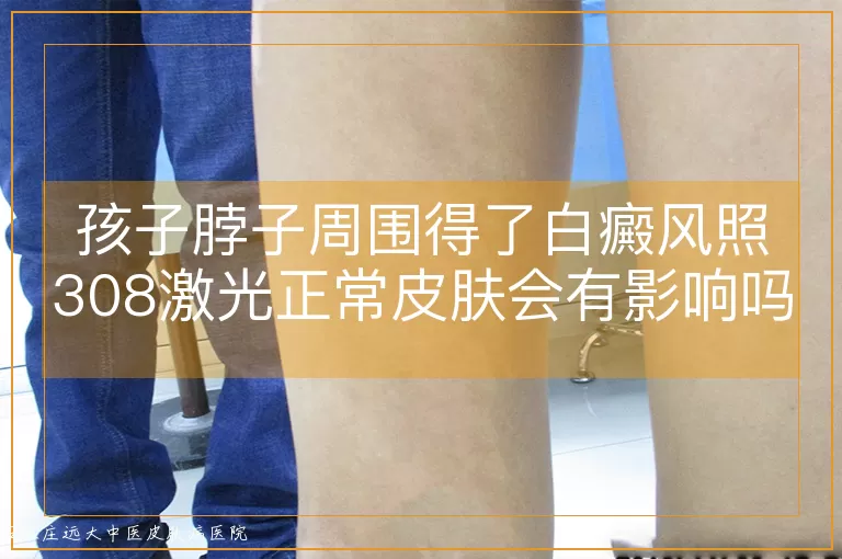 孩子脖子周围得了白癜风照308激光正常皮肤会有影响吗