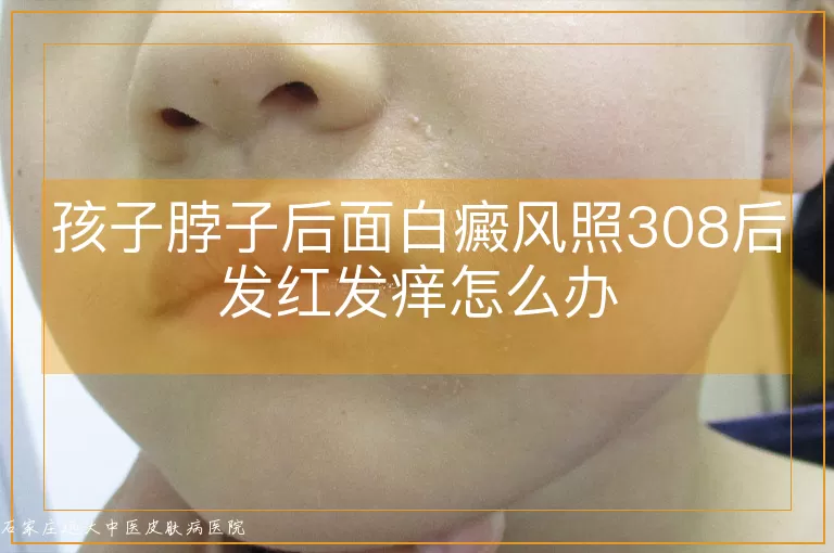 孩子脖子后面白癜风照308后发红发痒怎么办