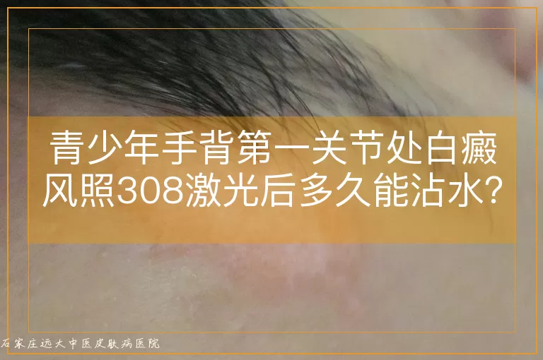 青少年手背第一关节处白癜风照308激光后多久能沾水？