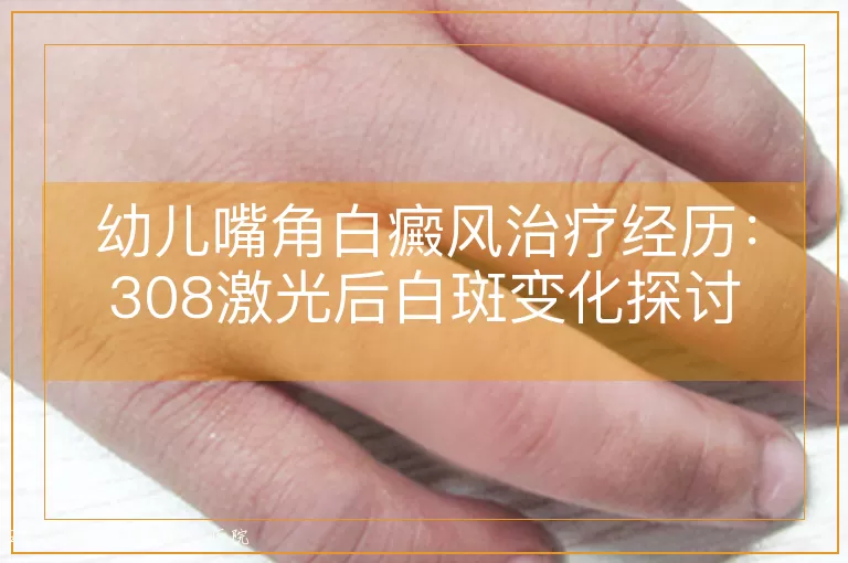幼儿嘴角白癜风治疗经历：308激光后白斑变化探讨