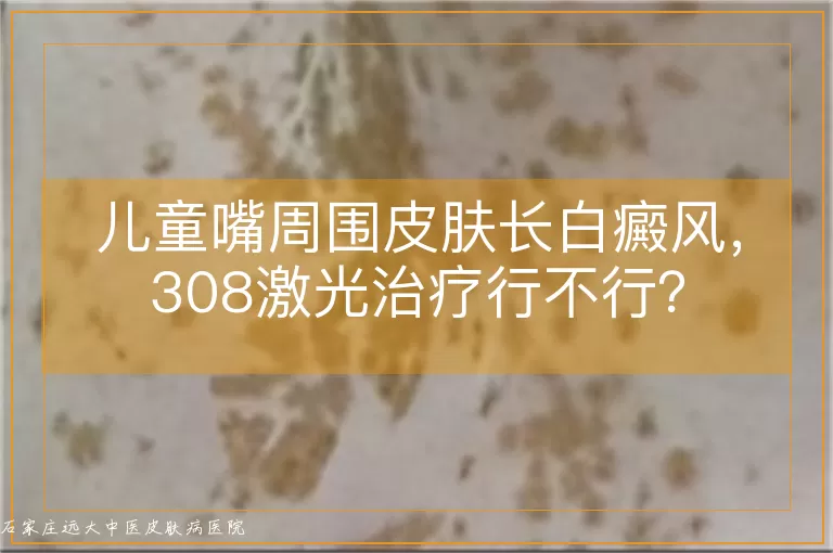 儿童嘴周围皮肤长白癜风，308激光治疗行不行？