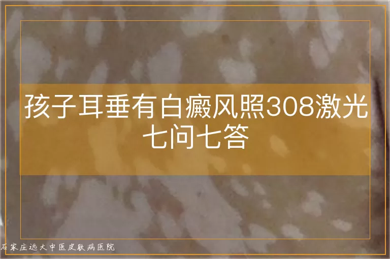 孩子耳垂有白癜风照308激光七问七答