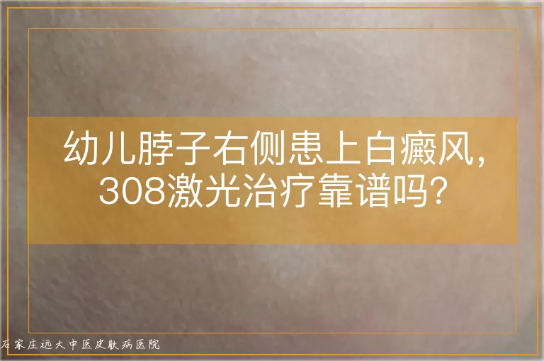 幼儿脖子右侧患上白癜风，308激光治疗靠谱吗？
