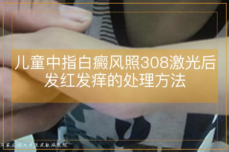 儿童中指白癜风照308激光后发红发痒的处理方法