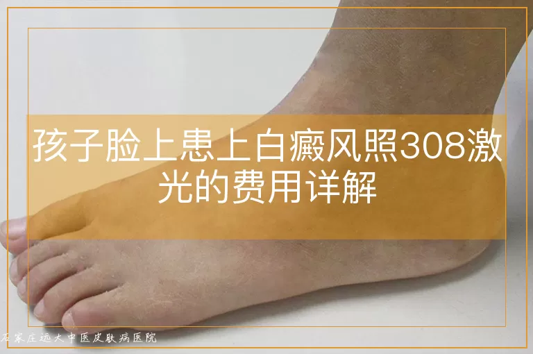 孩子脸上患上白癜风照308激光的费用详解